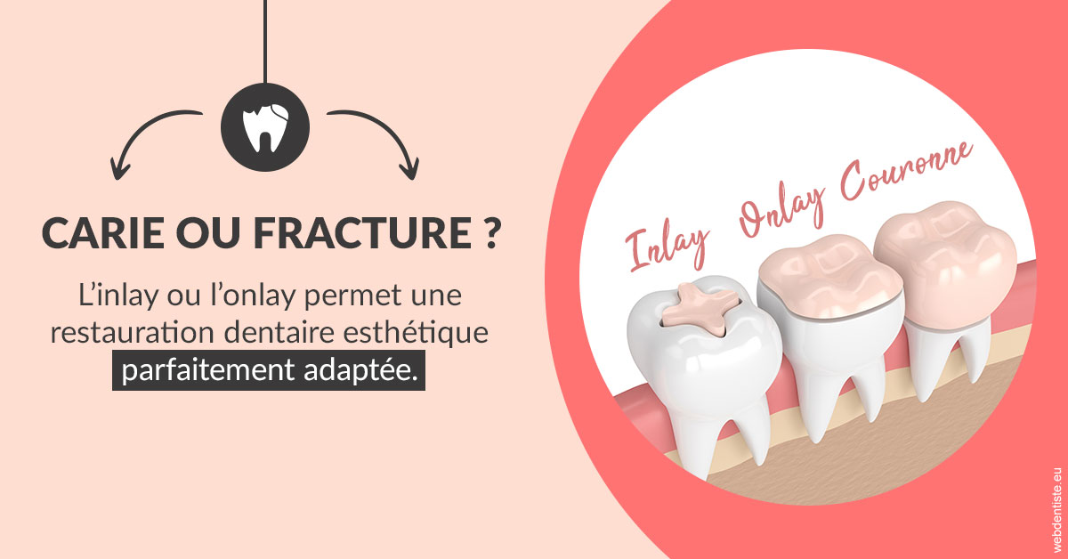 https://dr-corinne-schneider-pigeroulet.chirurgiens-dentistes.fr/T2 2023 - Carie ou fracture 2
