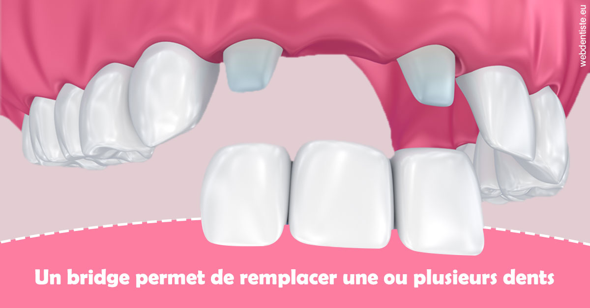 https://dr-corinne-schneider-pigeroulet.chirurgiens-dentistes.fr/Bridge remplacer dents 2