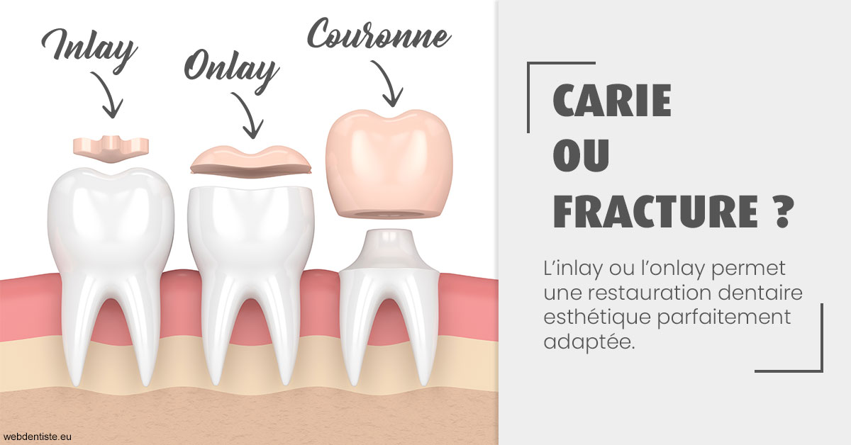 https://dr-corinne-schneider-pigeroulet.chirurgiens-dentistes.fr/T2 2023 - Carie ou fracture 1