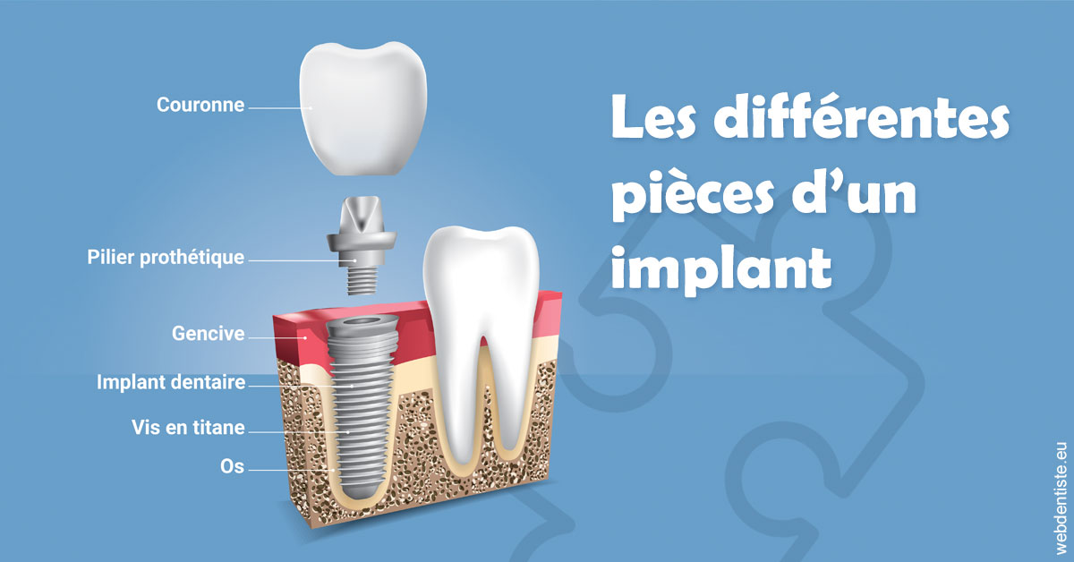 https://dr-corinne-schneider-pigeroulet.chirurgiens-dentistes.fr/Les différentes pièces d’un implant 1